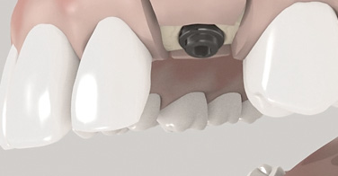 3D - Aufklärungsanimation - Implantat in einem Schritt