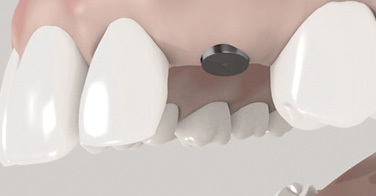 3D - Aufklärungsanimation - Implantat in zwei Schritten